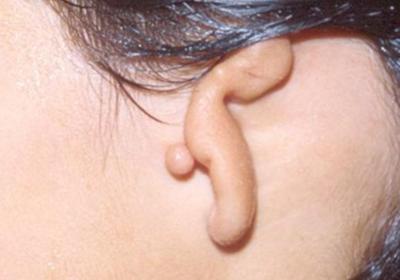 Ear reshaping surgery 