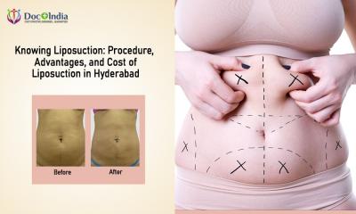 Affordable Liposuction Cost in Hyderabad for a Flawless Look