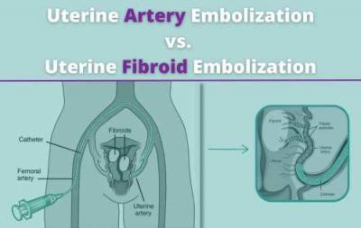 Achieve Fibroid Relief with Uterine Artery Embolization