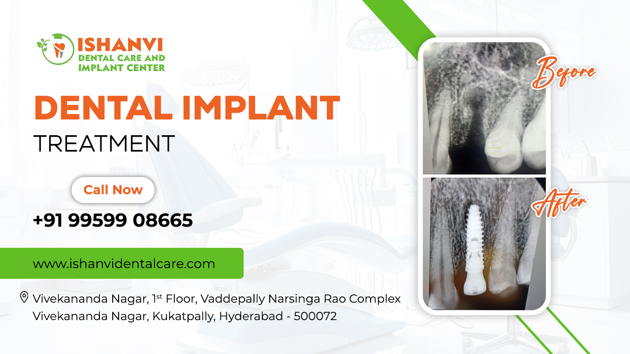 Best Dental Implants Vivekananda Nagar - Hyderabad Other