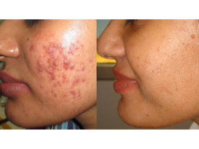 Acne Treatment in Lucknow - Lucknow Health, Personal Trainer