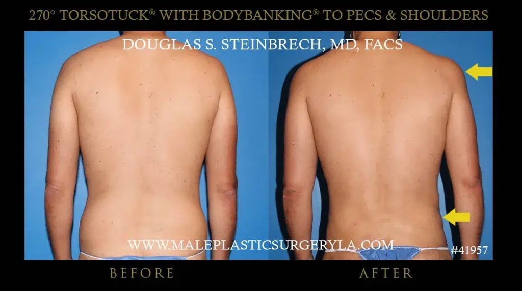 Tummy Tuck for Men Los Angeles for a Sculpted Abdomen