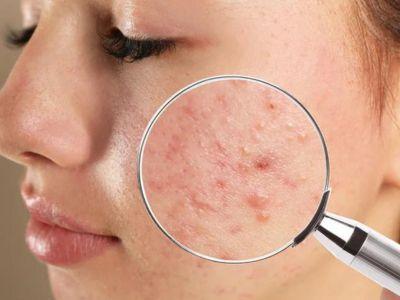 Acne Treatment in Lucknow