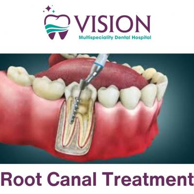 Painless  Root canal treatment in Guntur- Vision Multi Specialty Dental Hospital