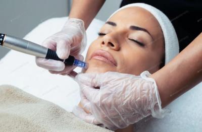 Microneedling and Chemical Peel Near Me - Other Other