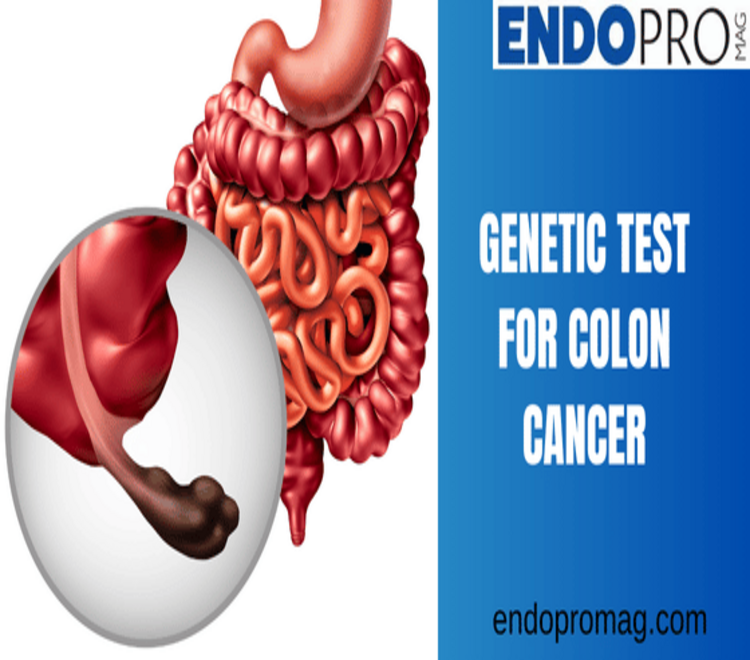 Exploring the Accuracy of Genetic Tests for Colon Cancer Risk