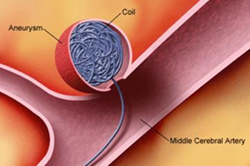 Mechanical Thrombectomy treatment in Gurgaon