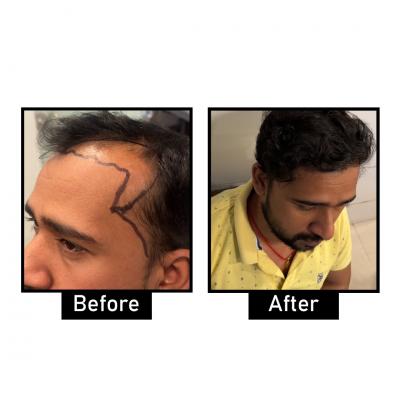 best hair transplant in delhi ncr - Los Angeles Other