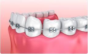 Dental braces in Abudhabi - Dubai Health, Personal Trainer