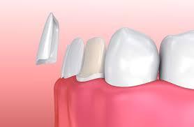 Dental veneers Abudhabi - Dubai Health, Personal Trainer