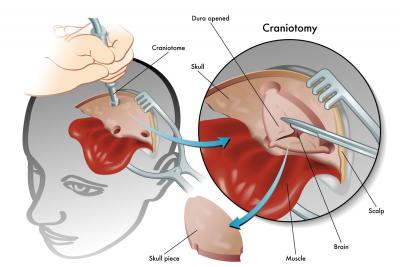 Cranial Surgery: Reducing Risks with Navigation Technology