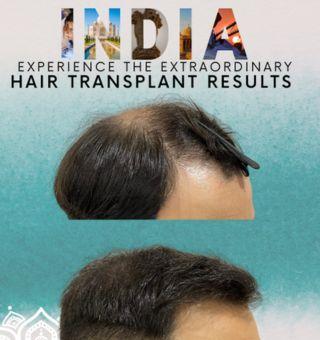 Hair Transplant Clinic in Mumbai