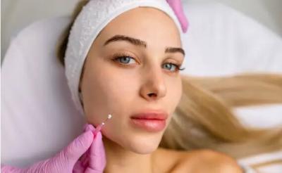 Thread Lift Treatment in Delhi