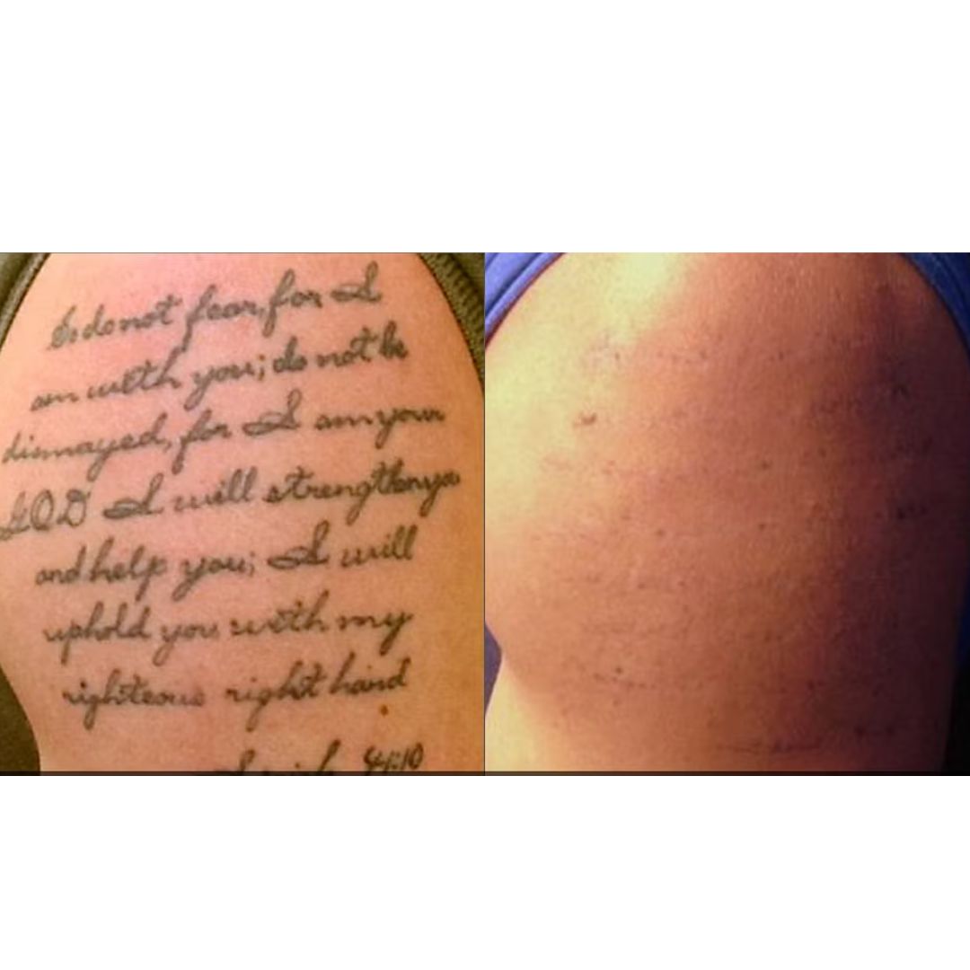 Laser Tattoo Removal in Mississauga - Other Other