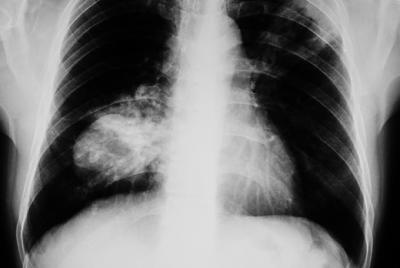 Lung cancer