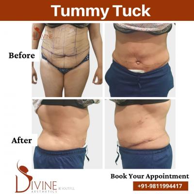 Tummy Tuck Surgery in Delhi | Achieve a Toned, Flat Stomach at Divine Cosmetic Surgery