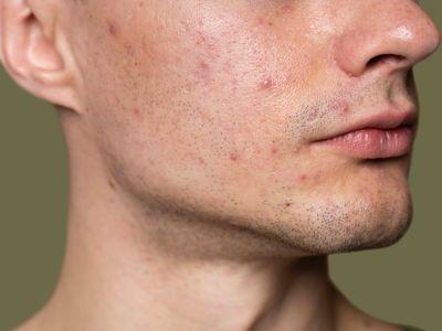 Acne Treatment in Lucknow - Lucknow Health, Personal Trainer