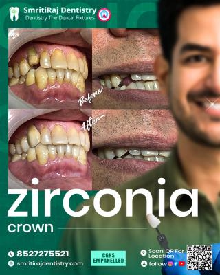 Best Dental Crown in Delhi – Restore Your Smile Today!