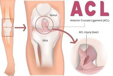 Expert ACL Ligament Surgery in Bihar for Faster Recovery