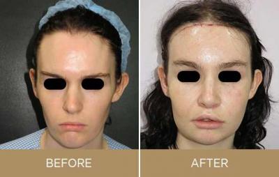 Facial Feminization Surgery UK - London Health, Personal Trainer